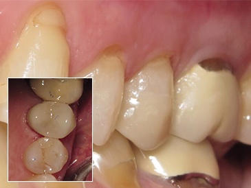 dental implants Toronto