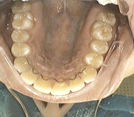 Dental Implants Richmond BC