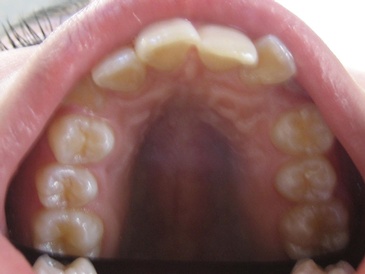 Teeth Whitening Richmond BC