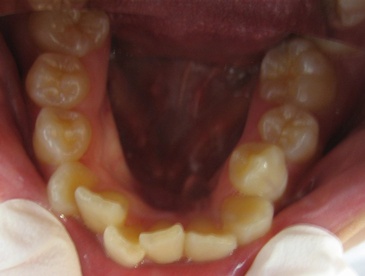 Teeth Whitening Richmond BC