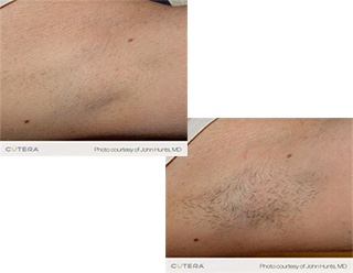 Hair Removal Chilliwack