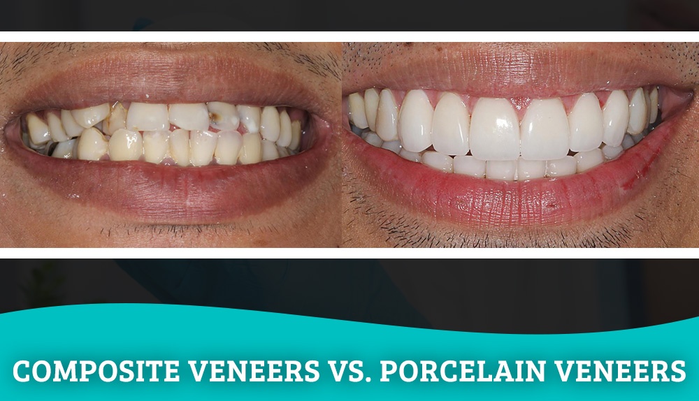 bonding on teeth vs veneers