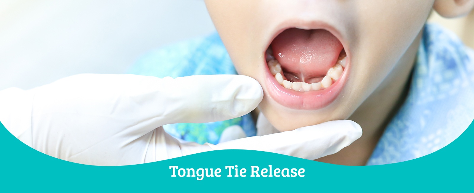 Tongue Tie Release Treatment in Toronto, ON