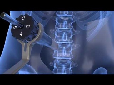 Osseus Spine Solutions Part 4 Video by Hurst Digital