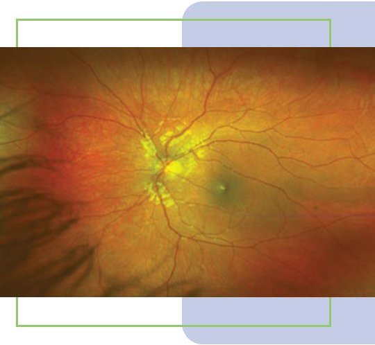 Interactive Optomap Image Discussion During Your Eye Exam in Markham