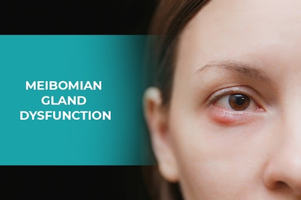 Meibomian Gland Dysfunction - Eye Checkup London ON