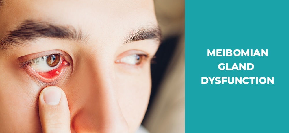 Meibomian Gland Dysfunction - Eye Clinic London Ontario