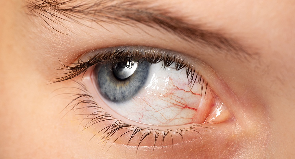 Ocular surface disease.jpg