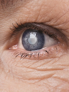 Cataract Treatment at Wesbrook Eyecare Optometry - Eye Clinic Vancouver