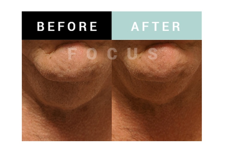 Before and After Results of a Massage Therapy by Focus Body Care