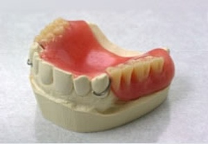 Example of an acrylic partial upper denture