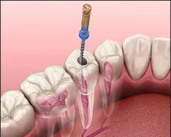 Performing Root Canal endodontic treatment is a service we offer at our Whitby Dental Office