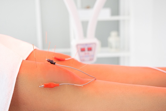 Electroacupuncture Therapy Surrey