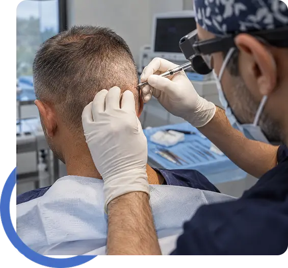 FUE Hair Transplant in San Francisco