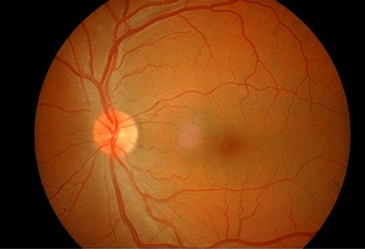 Cataract in Markham