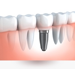 Dental Implants in Belleville