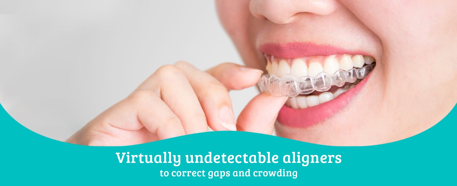 Virtually Undetectable Aligners - Dentistry Services by Dentists in Toronto, ON