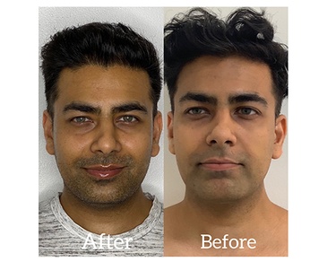 Mihir Facial Treatment in Richmond, BC