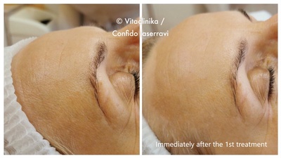 Oxygeneo before & after