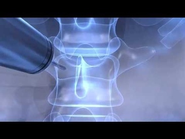Osseus Spine Solutions Part 2 Video by Hurst Digital