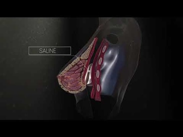 Saline IMPLANT Breast Animation