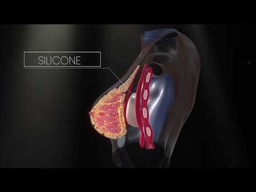 Silicone IMPLANT Breast Animation