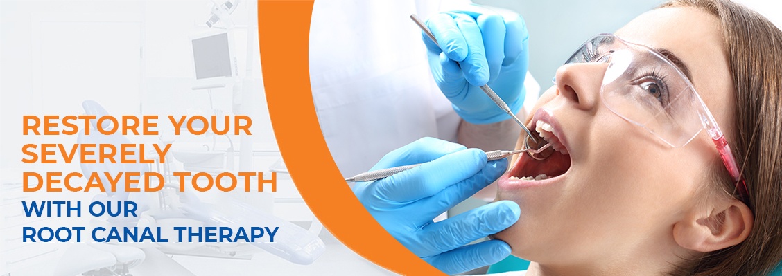 Restore your severely decayed tooth with our Root Canal Therapy