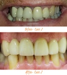 Dental Filling Treatment Maple Vaughan by Dentistry on Jane