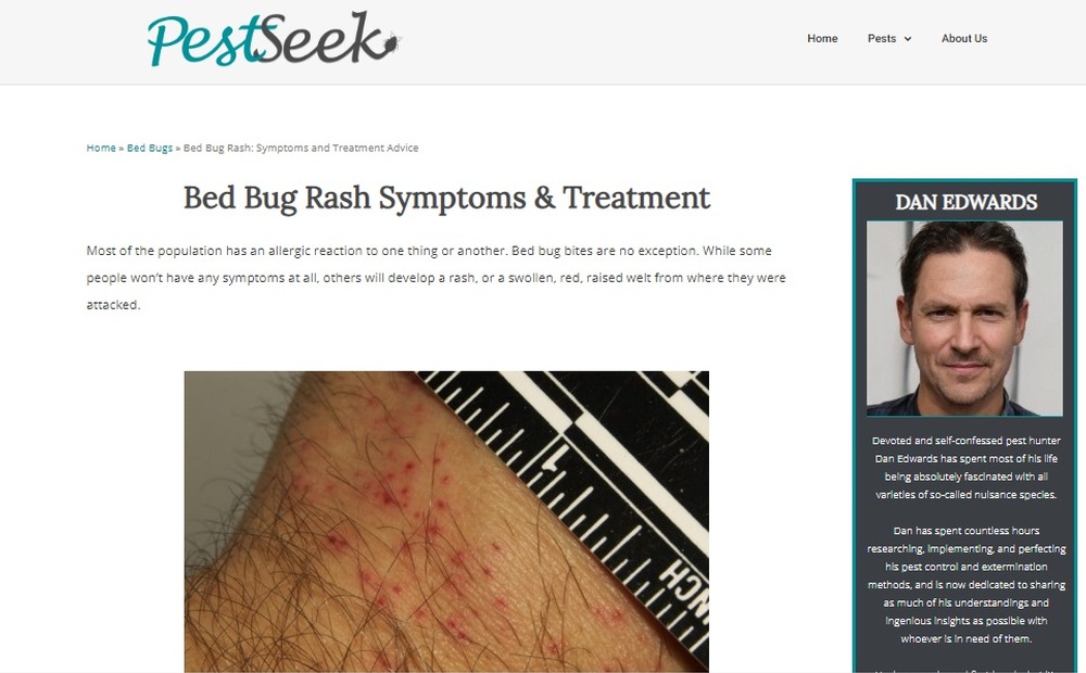 Bed_Bug_Rash_Symptoms_and_Treatment_Advice_PestSeek.jpg