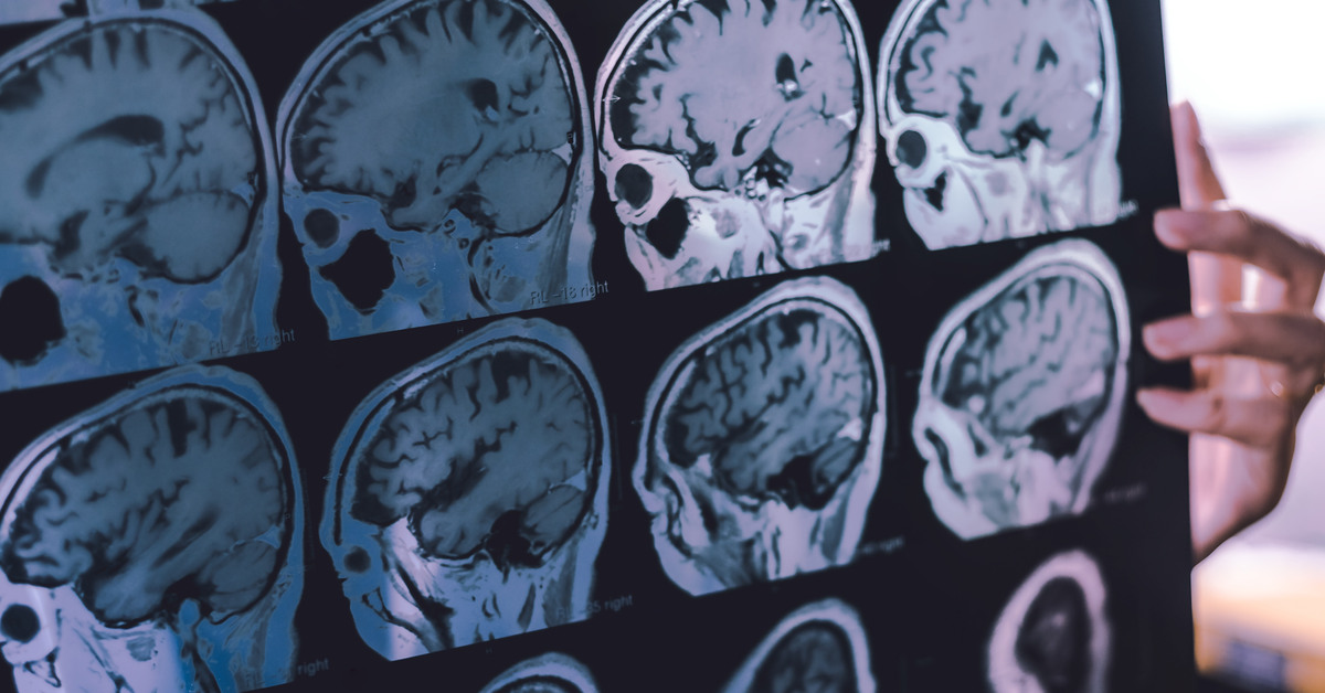 A hand holding up a sheet of printed film that shows the results of an MRI scan of the frontal lobe in the brain.