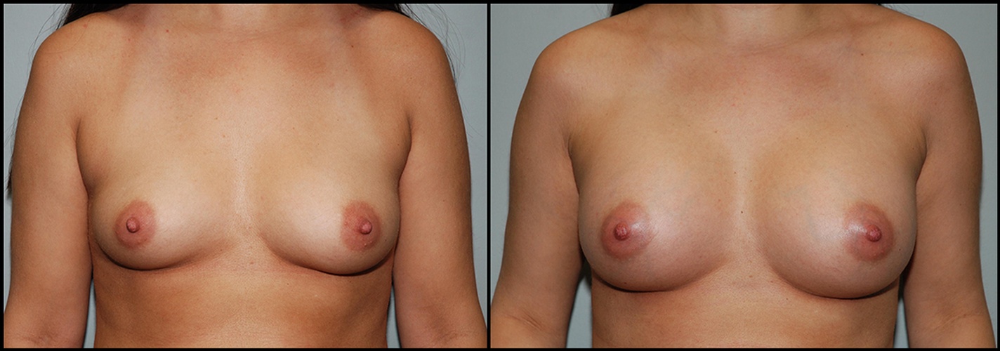 breast surgery
