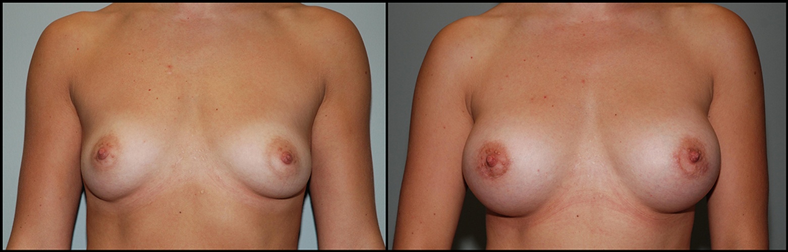 breast surgery