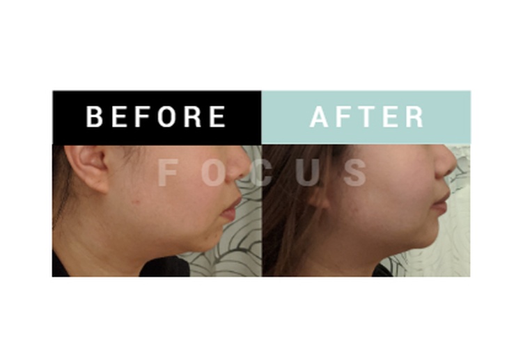 Before and After a Massage Therapy by Focus Body Care in Edmonton, Leduc 