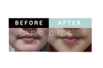 Before and After Comparison of a Massage Therapy by Focus Body Care