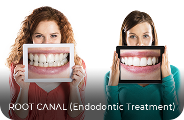Root Canal (Endodontic Treatment)