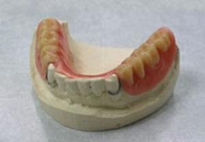 Example of an acrylic partial lower denture