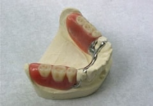 Example of a cast lower partial denture
