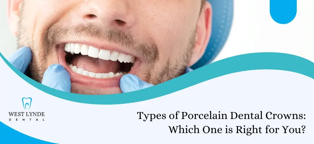 Discover the comprehensive blog on various types of porcelain Dental Crowns through West Lynde Dental