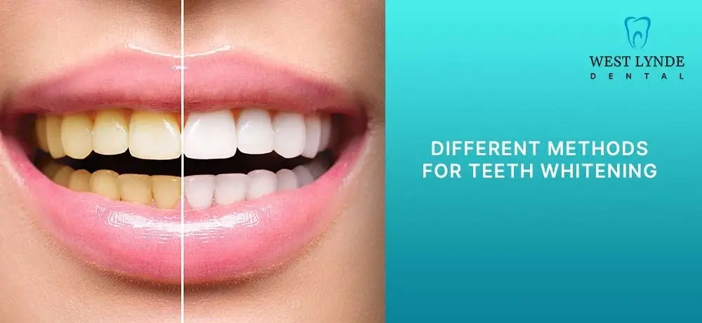 Explore the informative article by West Lynde Dental diverse methods for effective Teeth Whitening