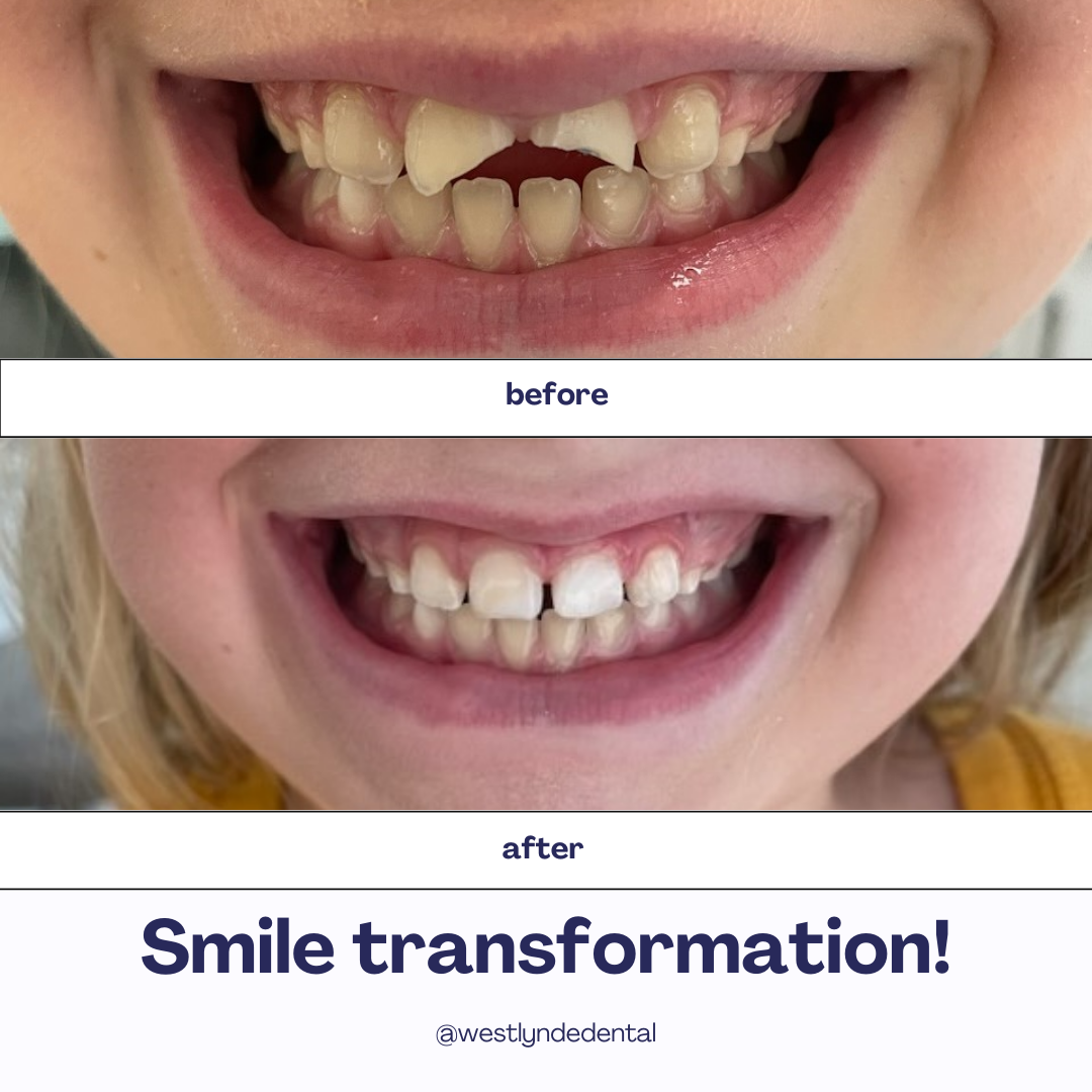 Smile Transformation!