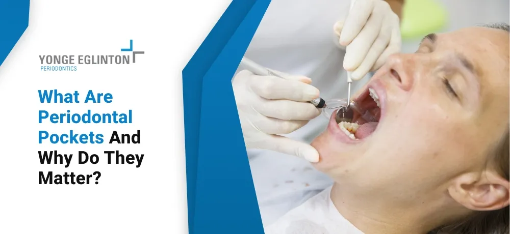 Blog by Yonge Eglinton Periodontics