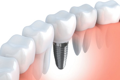 Dental Implants Vaughan
