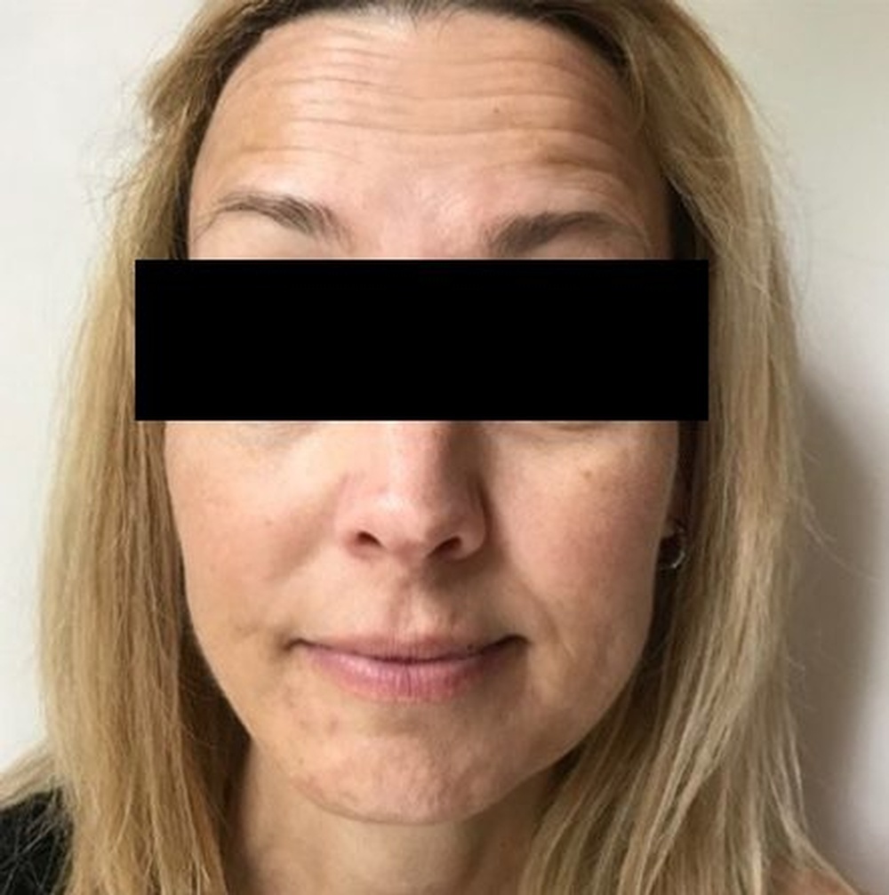 Face before Wrinkle Relaxer Treatment is damped and has spots