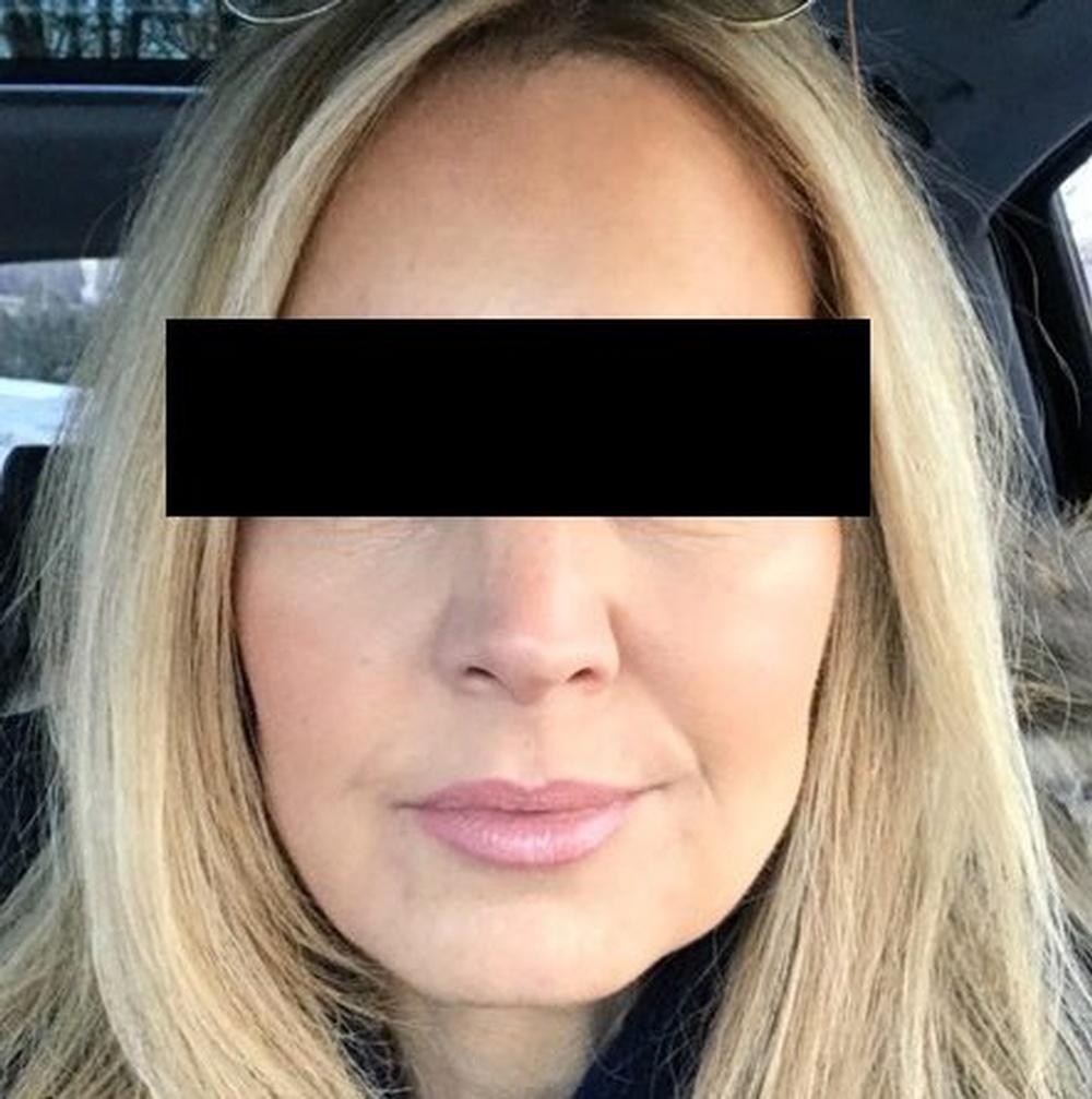 Face after Wrinkle Relaxer Treatment at CLINIQUE AG in Laval, Montreal