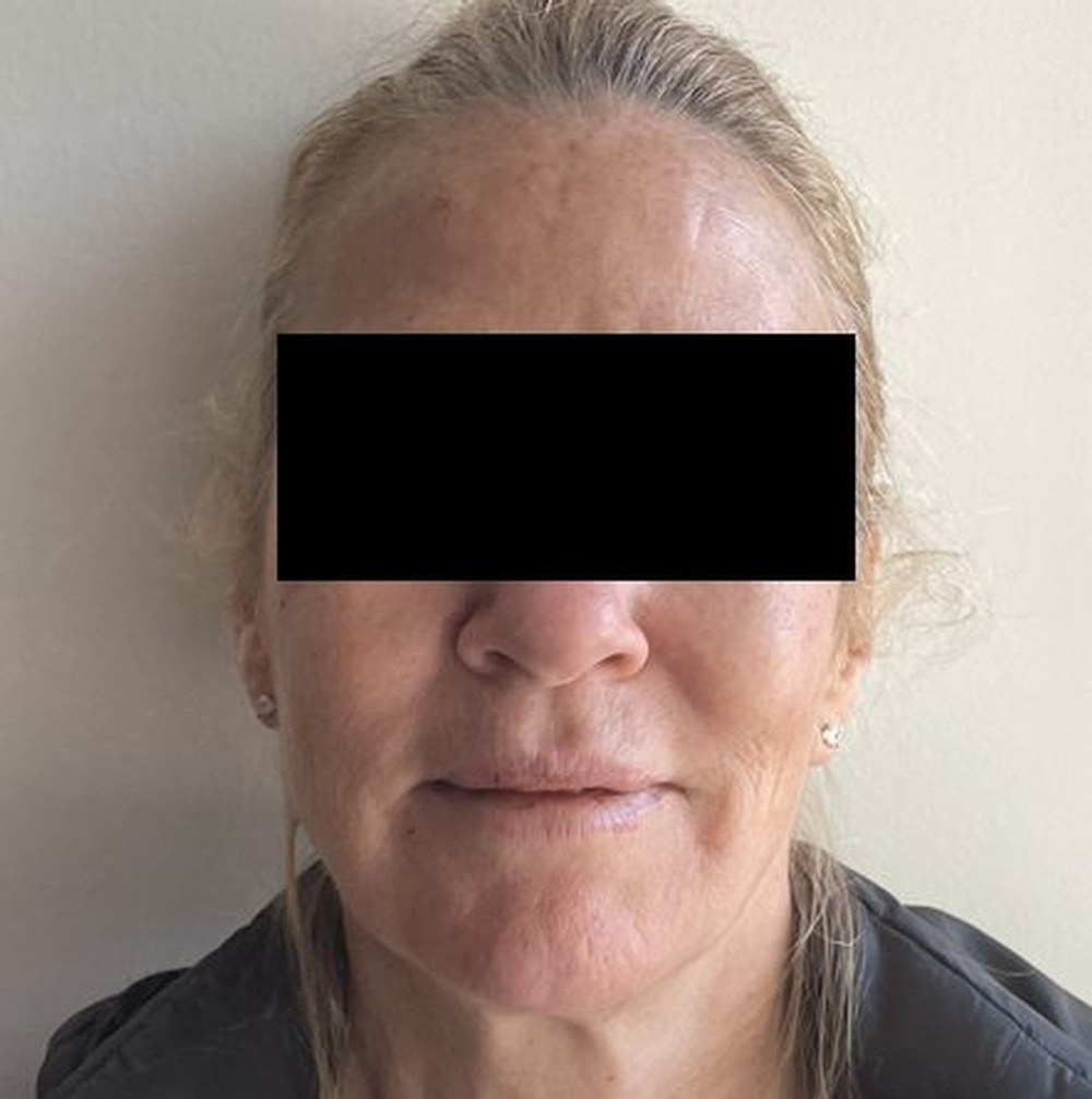 Face after Wrinkle Relaxer Treatment at CLINIQUE AG - Medical Clinic in Laval, Montreal