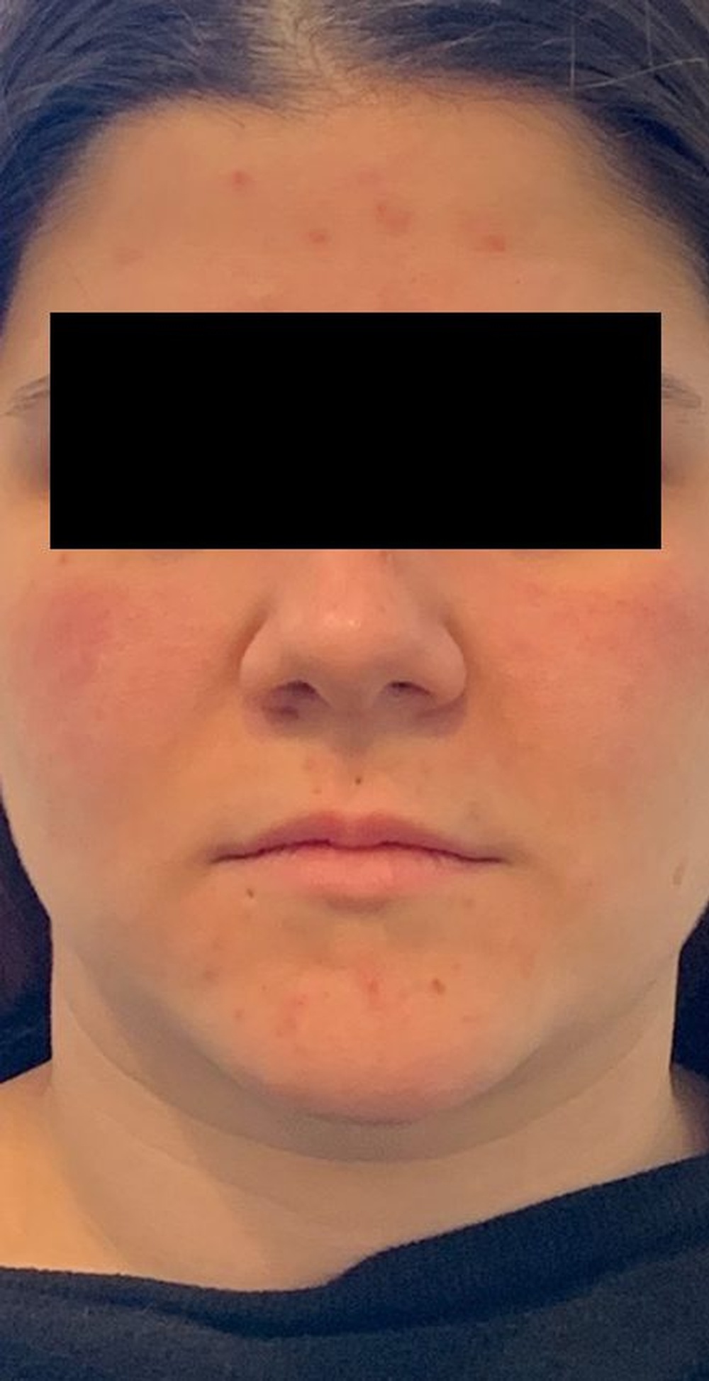 Face before Dermafiller Treatment has acne and lips are damped