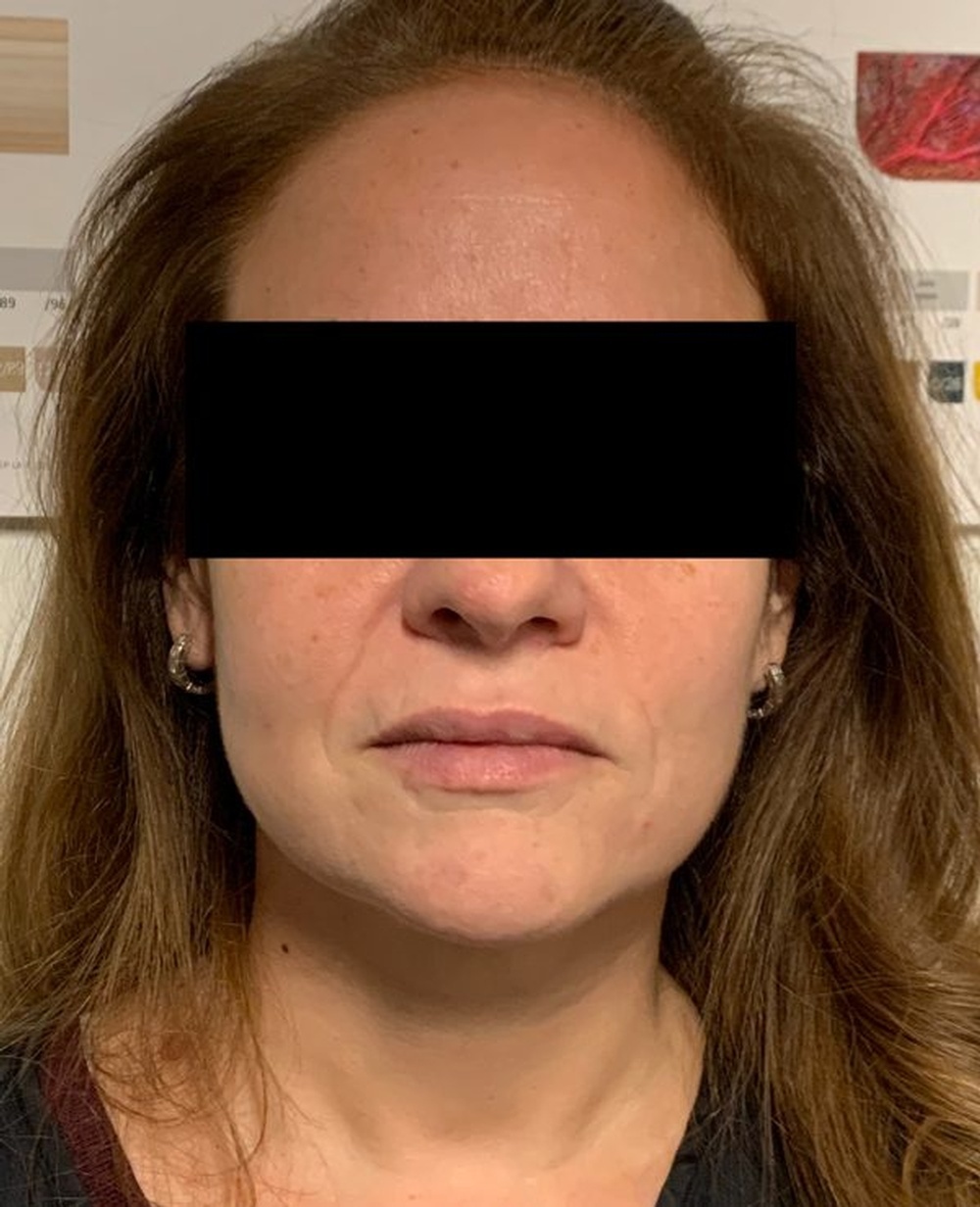 Face before Cheeck Volumization loses volume due to reduced fat and muscle mass