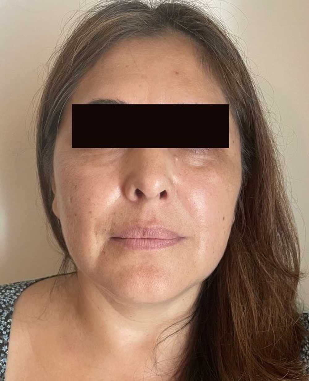 Face before Cheeck Volumization and Marionette Lines Treatment