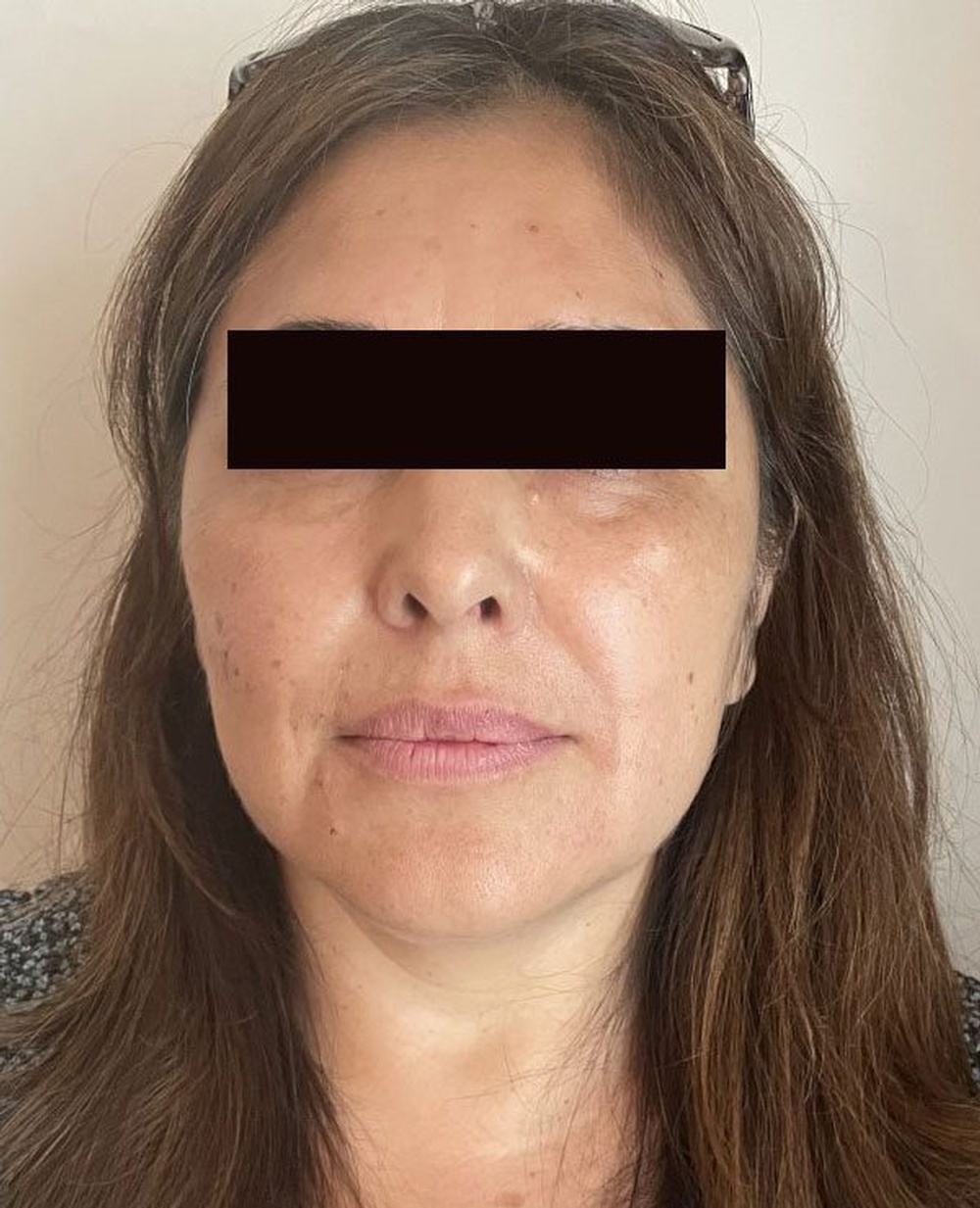 Cheeck Volumization and Marionette Lines Treatment using Dermafiller Treatment at CLINIQUE AG in Laval, Montreal