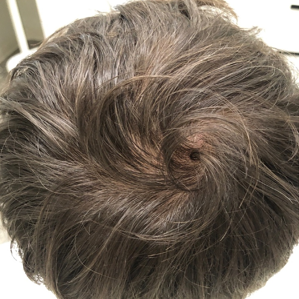 Hair Loss Treatment using PRP Therapy at CLINIQUE AG in Laval, Montreal